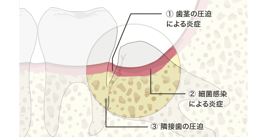 図:親知らずが痛む理由